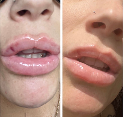 Bruise Bullie-Arnica Infused Lip Gloss for Post Lip Augmentation Care