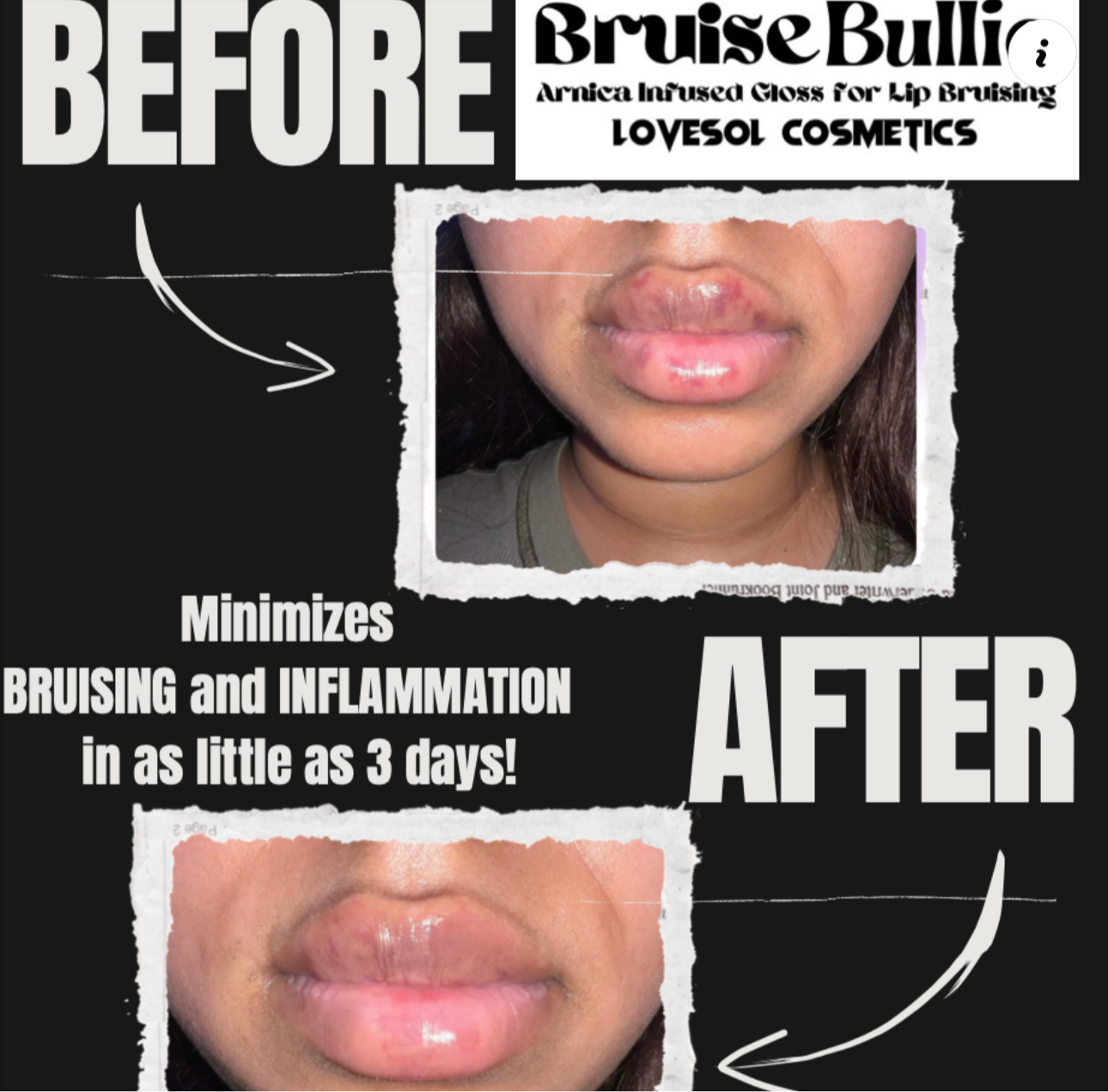 Bruise Bullie-Arnica Infused Lip Gloss for Post Lip Augmentation Care