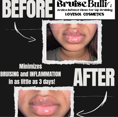 Bruise Bullie-Arnica Infused Lip Gloss for Post Lip Augmentation Care